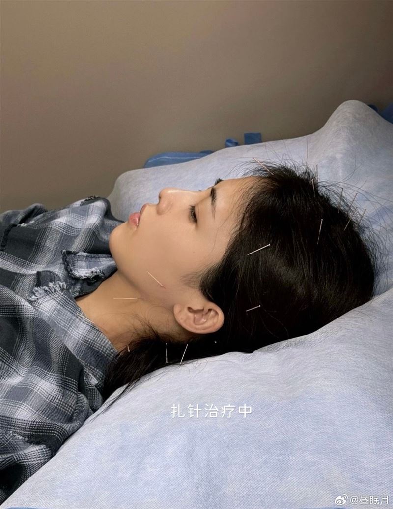 白鹿透過針灸和藥物治療來緩解風濕症狀。(圖/翻攝自微博)