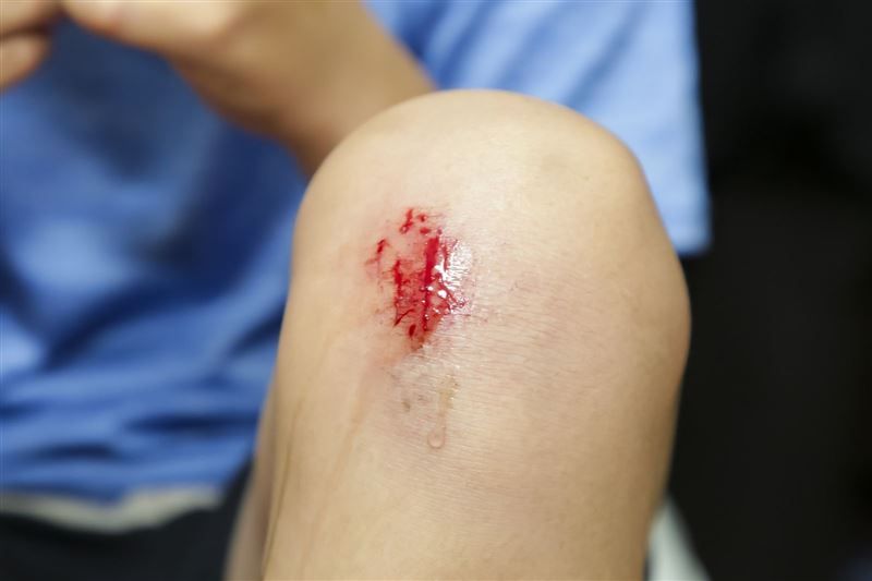 醫生建議受傷若不想留疤，第一天就要清創，並貼上人工皮維持濕潤環境。（示意圖，photoAC）