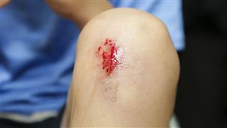 傷口結痂不是快癒合　整形醫：反而會留疤