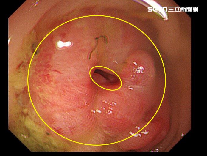27歲男碩士生平時吃素，因愛吃加工品、精緻澱粉與高溫油炸食物，罹患直腸癌並出現淋巴結轉移。（圖／翻攝畫面）