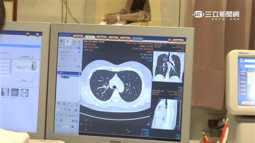 肺癌死亡率連22年奪冠！2類人享免費篩檢
