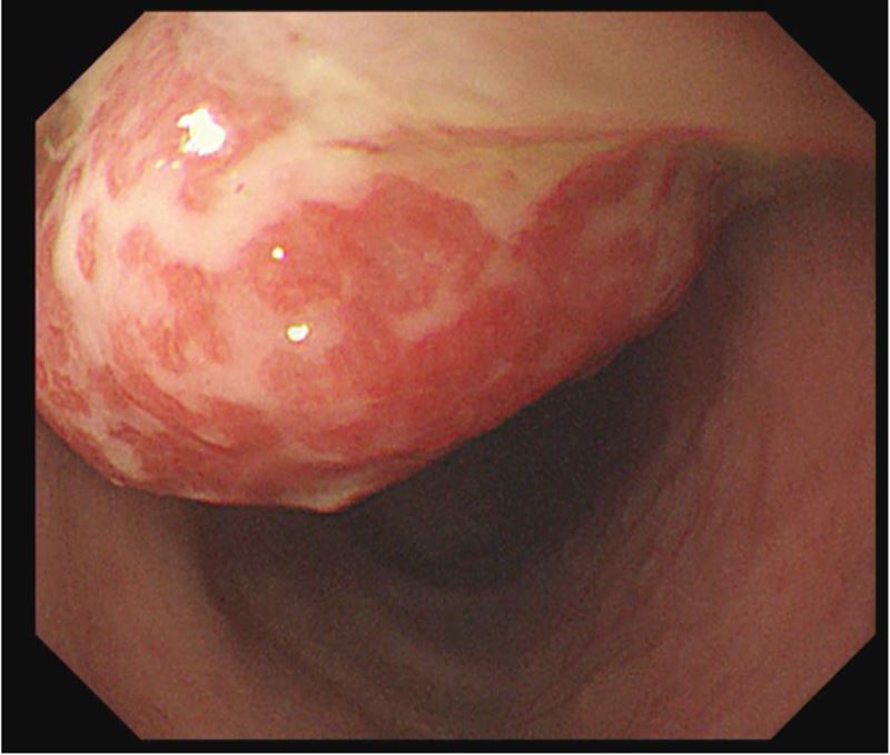 透過大腸鏡可以看到有一2公分大的息肉。(圖/台北慈濟醫院提供)