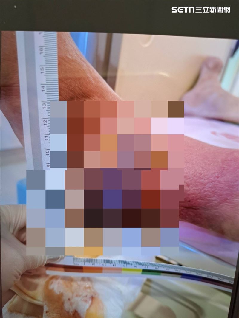 患者因有痛風又不忌口，就醫時腳踝痛風石腫得比雞但更大。(圖/亞大醫院提供)