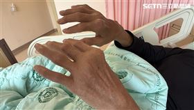 痛風,關節,痛風石(圖/亞大醫院提供)