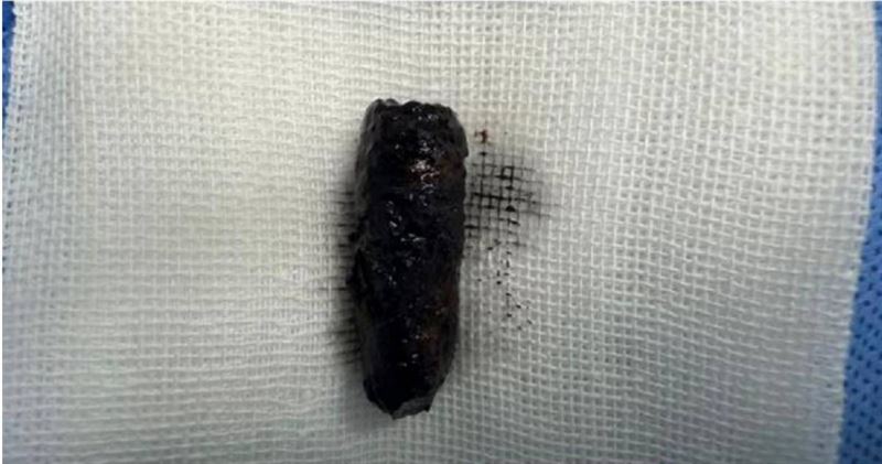 大陸湖北一名58歲男子鼻腔數個月反覆流膿還飄異味，檢查後接受手術從鼻腔取出一個3公分的螺絲釘。（圖／翻攝自微博／極目新聞）