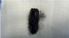 大陸湖北一名58歲男子鼻腔數個月反覆流膿還飄異味，檢查後接受手術從鼻腔取出一個3公分的螺絲釘。（圖／翻攝自微博／極目新聞）