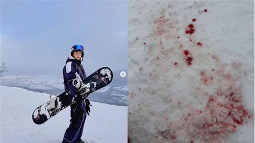 女星赴日滑雪「臉煞車」　血染雪地慘況曝