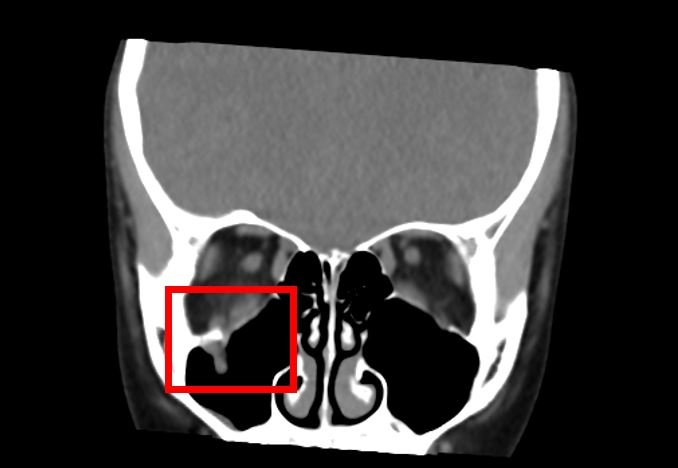 9歲女童右眼被同學膝蓋撞到，造成眼窩骨折，眼窩組織掉入上顎竇，導致眼球活動受到影響。(圖／中山醫大附醫提供)