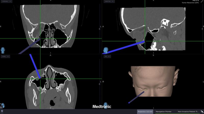 醫療團隊運用創新電腦數位模擬技術，術中搭配內視鏡與精密導航系統，精準定位眼底嵌頓肌肉的位置，成功將被夾住的眼底肌肉復位。(圖／中山醫大附醫提供)