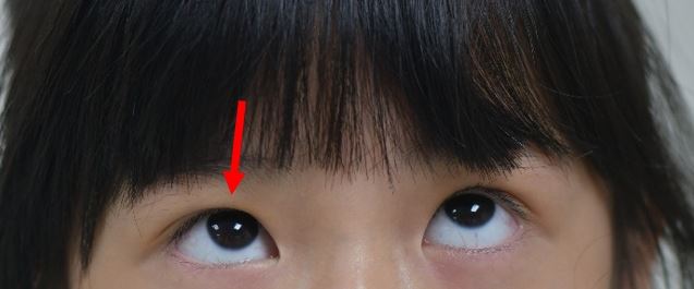 眼窩骨折造成右眼往上看的角度受限（圖上），經過手術（圖下）右眼可自由往上轉動。(圖／中山醫大附醫提供)