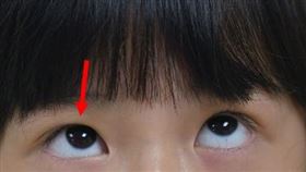 被同學膝蓋撞到，9歲女童，眼球無法轉動，眼窩骨折，複視(圖／中山醫大附醫提供)