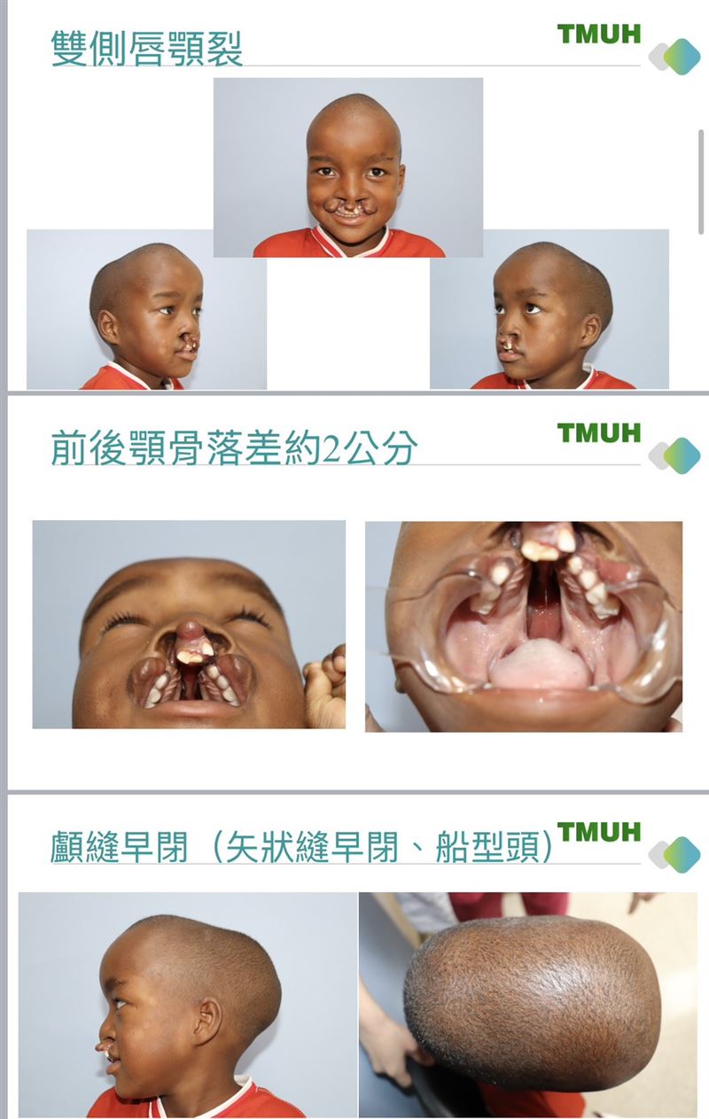 Boum於去年9月抵台，當時雙側唇顎裂、顱縫早閉，羊膜帶症候群導致左手手指併指與右腳發育不全，下肢沒有腳掌。（圖／北醫提供）