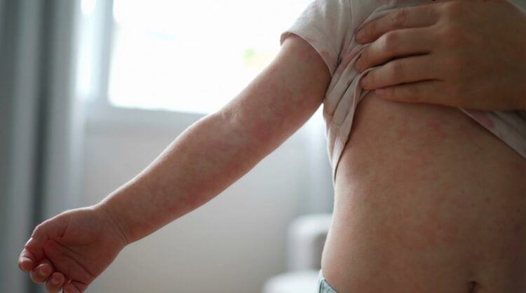 玫瑰疹只有退燒才長？與病毒疹差異在哪？會復發嗎？醫教7招判斷。（圖／醫健新聞網提供）