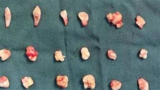 18歲女孩就醫驚見12cm腫瘤：內藏24顆牙齒