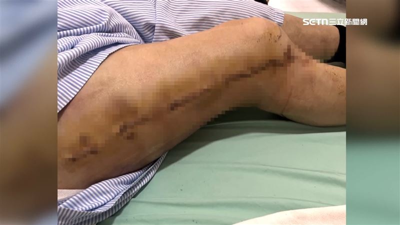 男子去新北某間國術館推拿，沒想到按著按著，大腿卻被按到骨折