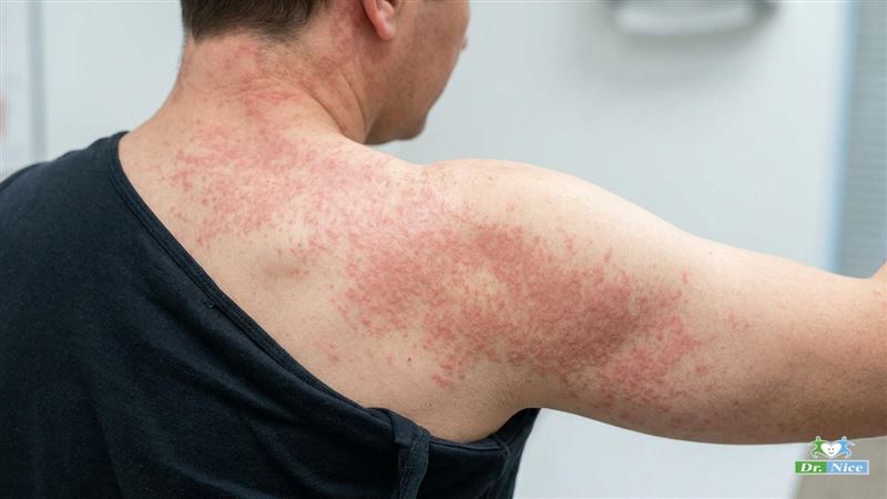 「春分」氣候多變！醫示警1族群易染麻疹