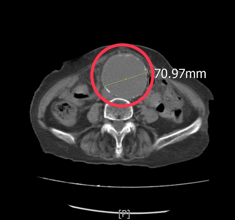 86歲阿嬤腹部的血管瘤直徑已超過7公分，一旦破裂恐造成大量內出血，死亡率極高。(圖／中港澄清醫院提供)