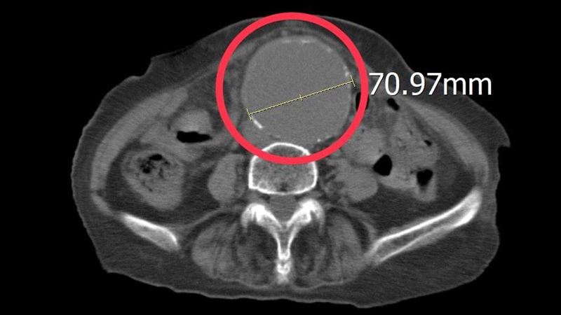 86歲嬤腿痛腰痠逾1週　竟是腹部沉默殺手