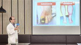 奇美醫院,台南,蜂窩性組織炎,病患,糖尿病（圖／奇美醫院提供） 