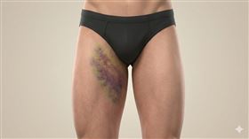 「福克斯徵象」（Fox’s sign） 圖／AI製圖