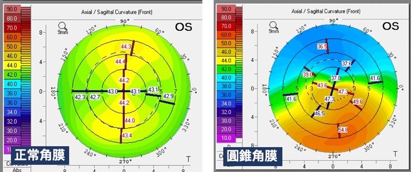 正常角膜和圓錐角膜角膜地形圖。(圖／基隆長庚醫院提供)