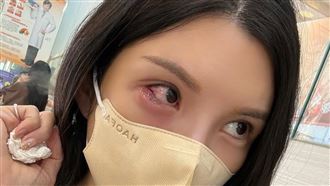 國光女神長針眼沒顧好變超嚴重！引發這病