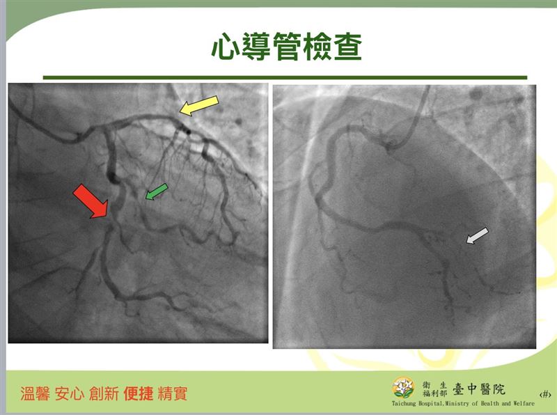 34歲男子睡前打手遊突然感到胸痛、冒冷汗,送醫檢查竟是心肌梗塞。(圖/署立臺中醫院提供)