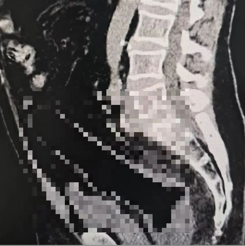 男子自稱坐到假陽具導致物品滑入肛門內。（圖／翻攝自網路）