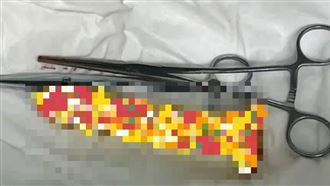 男「不慎坐到」假陽具滑入肛門！慘腸穿孔