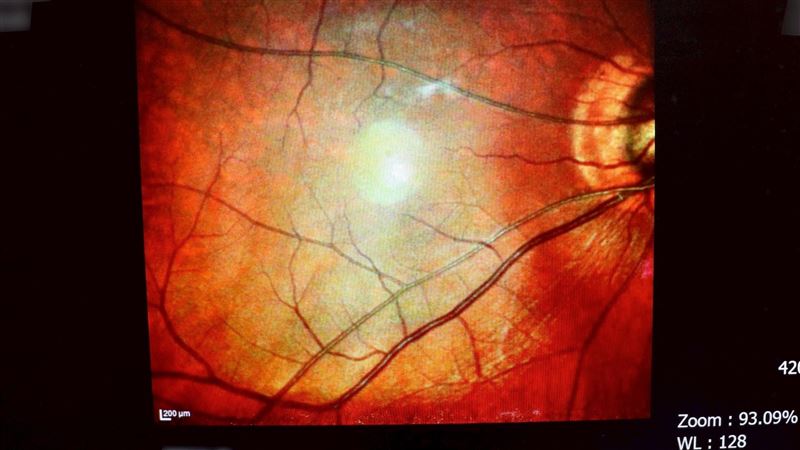 不吃甜也中 男無症狀罹糖尿病 隱藏殺手曝