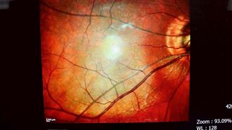 不吃甜也中 男無症狀罹糖尿病 隱藏殺手曝