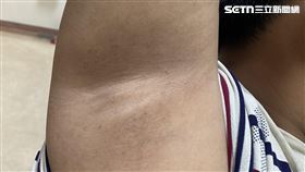 腋下,脖子,皮膚黑色,黑色棘皮症,台大醫院新竹分院,兒童內分泌科,兒童第二型糖尿病,糖尿病