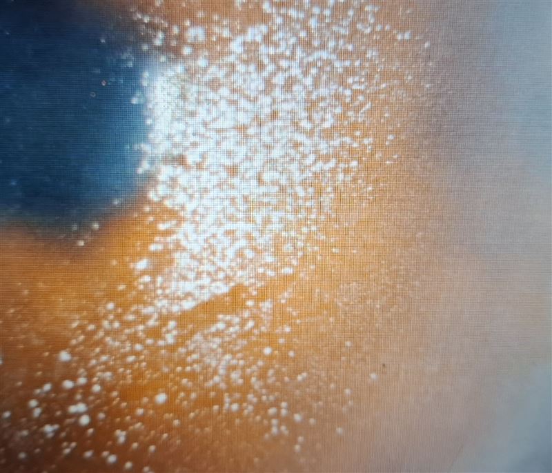 個案右眼出現大片角膜上皮病變，容易造成嚴重異物感、流淚不止與疼痛感。（圖／洪啟庭提供）