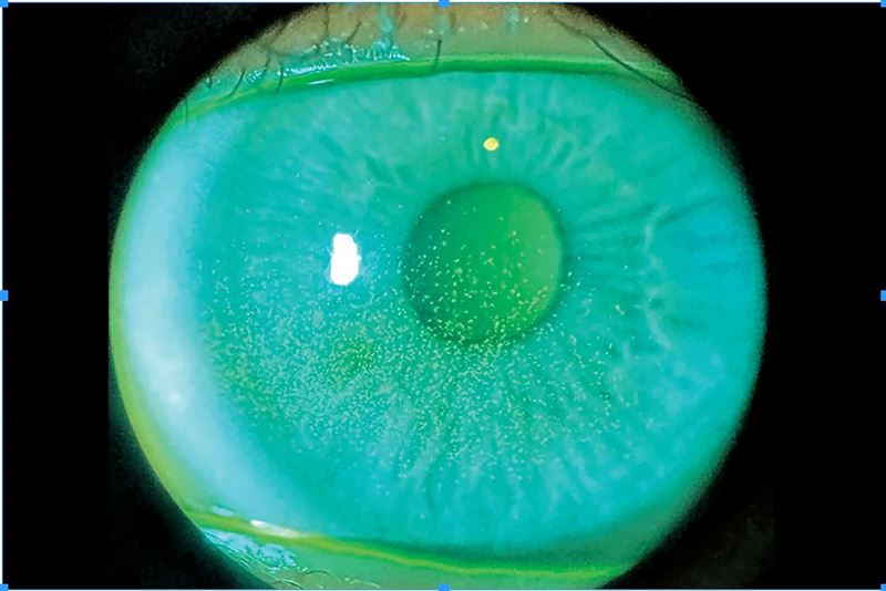 螢光染色後，個案左眼出現角膜中央有大範圍的點狀上皮缺損，因此會有眼睛刺激、畏光、視力減低。（圖／洪啟庭提供）