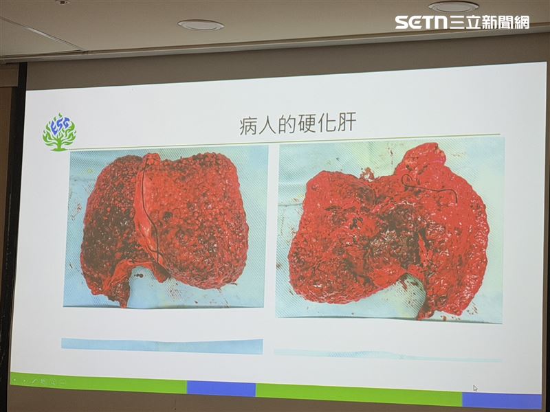 米德莉本該平滑的肝臟，變得像苦瓜凹凸不平、且脾臟腫大導致白血球、血小板偏低，評估需要換肝。（圖／記者蔣季容攝影）（圖／記者蔣季容攝影）