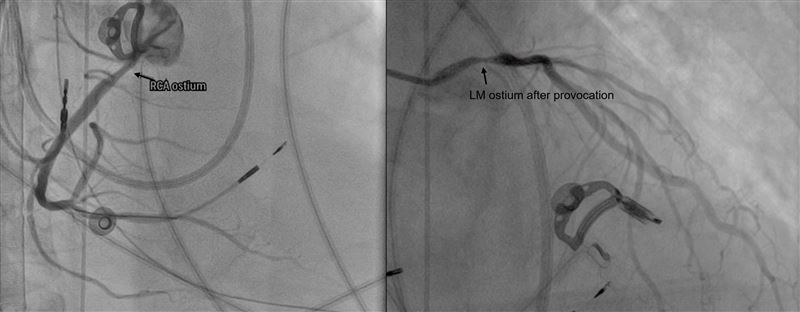 箭頭位置為藥物誘發下，雙側冠狀動脈明顯痙攣處，是造成心臟缺血與心跳停止的關鍵證據。（圖／台北慈濟醫院提供）
