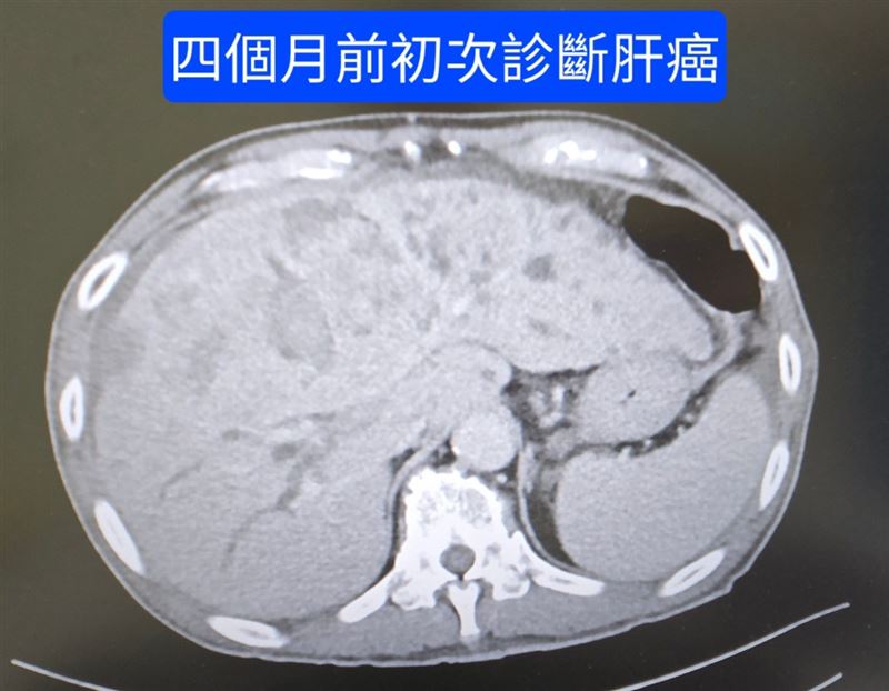 胃腸肝膽科醫師林群峰分享，一名肝癌患者拒絕正規治療，堅持服用自製草藥，4個月後肝臟快速長滿腫瘤，最後只能轉診尋求醫學中心治療。（圖／胃腸肝膽科醫師林群峰授權提供）