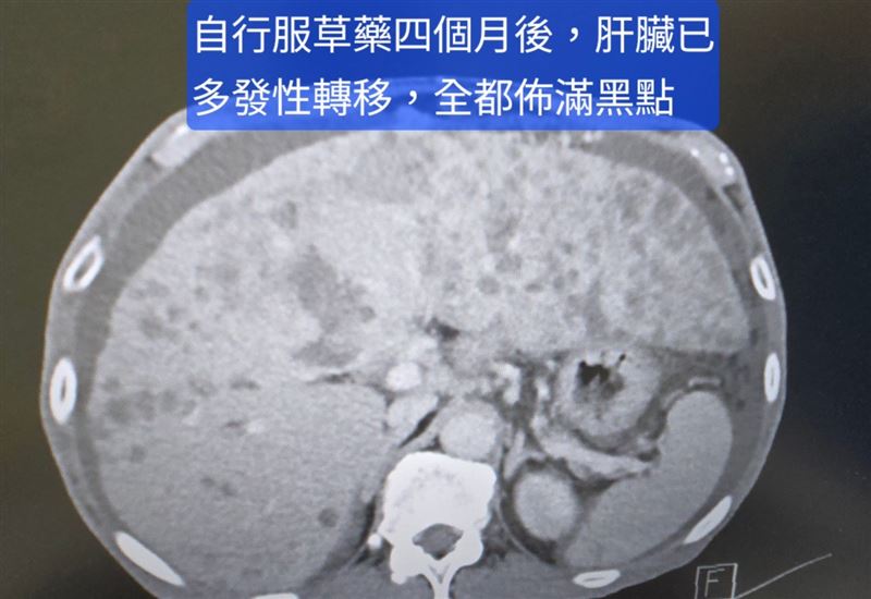 林群峰指出，患者4個月後因腹痛回急診，肝癌快速惡化、整肝腫瘤滿布，黃膽肝指數升高，病情危急。（圖／胃腸肝膽科醫師林群峰授權提供）