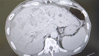 肝癌破裂！男拒醫堅持吃草藥 4個月後悔了