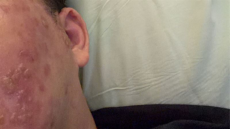 工程師牙痛3天無法入睡,拔牙後驚見水泡爬滿半張臉,就醫確診帶狀皰疹。(圖/亞大附醫提供)