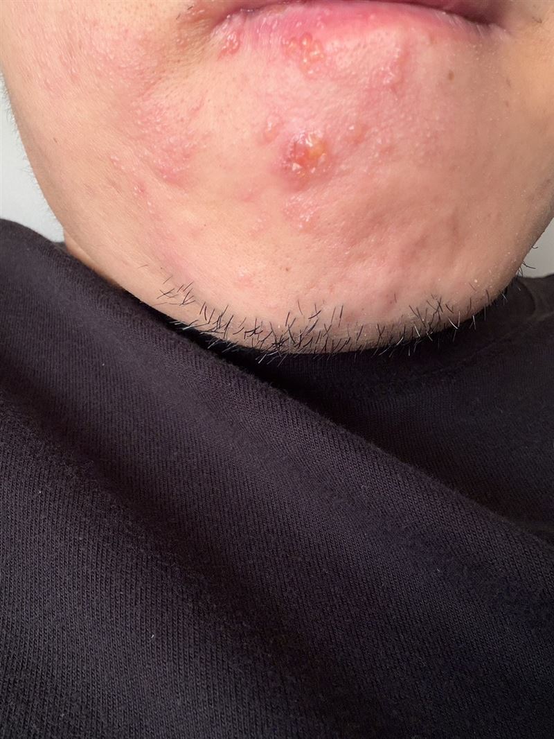 工程師牙痛3天無法入睡,拔牙後驚見水泡爬滿半張臉,就醫確診帶狀皰疹。(圖/亞大附醫提供)