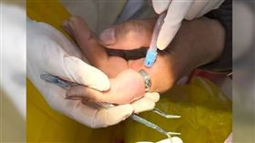 北京協和醫院收治一名手指被戒指勒太緊的女子，最後由牙醫操作器材救援成功。（圖／翻攝自微薄極目新聞）