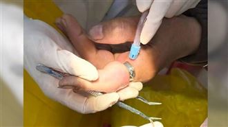 戒指太緊！女子手指腫到爆　這科醫師救援