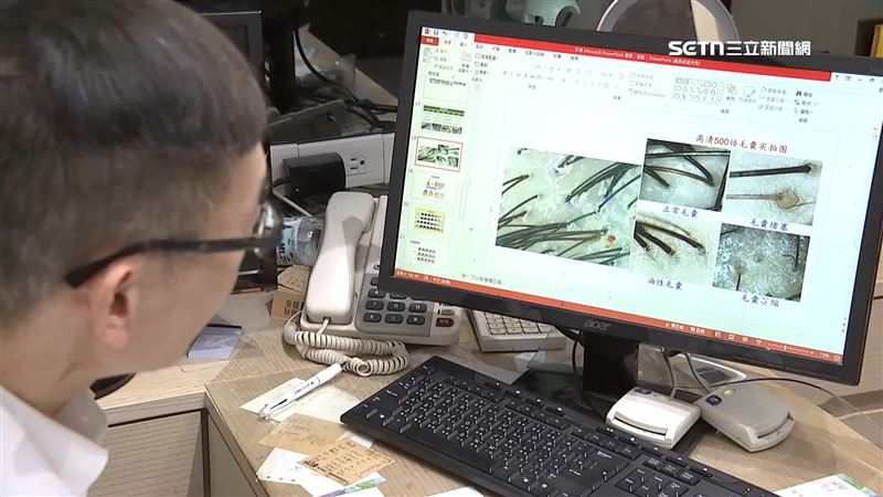 掉髮年齡層下降，也跟壓力、作息、飲食不正常息息相關