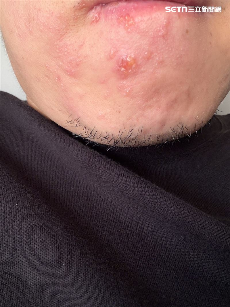 患者帶狀皰疹侵犯部位在頭部,導致嘴唇、臉頰及眼睛周邊都出現水泡症狀。(圖/翻攝畫面)