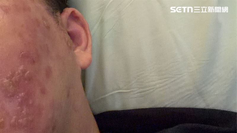 牙痛失眠不是「牙」!3天竟引「蛇」出洞