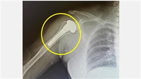 5旬女運匠，肩膀痛，以為「五十肩」，關節磨損，全人工肩關節置換(圖／仁愛長庚合作聯盟醫院提供)