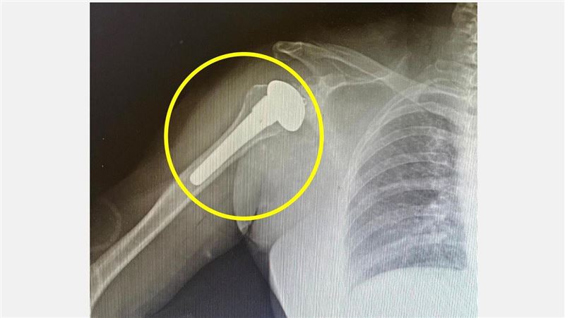 肩膀痛以為50肩!50歲女運將關節竟全磨損