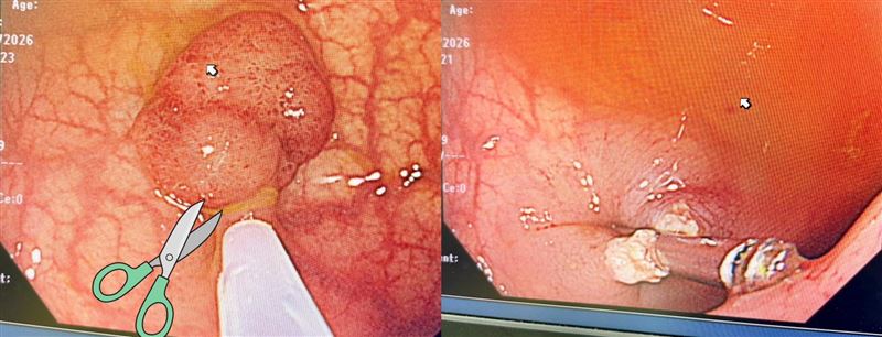 沒有家族病史也可能長出腺瘤性息肉，只有定期大腸鏡檢查，才能及早發現切除，杜絕後患。（圖／翻攝自張靖醫師臉書）
