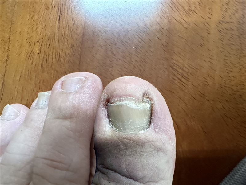 凍甲非小問題，嚴重恐紅腫化膿。大林慈濟醫院皮膚科醫師林騰立指出，多與修剪不當、鞋子過緊或指甲變形有關，建議平剪指甲、避免擠壓；若反覆疼痛發炎，應及早就醫治療。（圖／大林慈濟醫院提供）